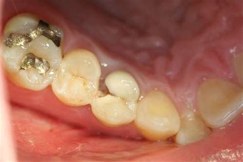 Flaps Dentistry Blog The Daily Extraction Upper Right First Premolar