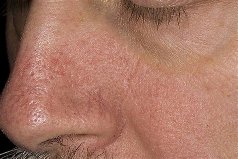 Seborrheic Dermatitis On Nose Pictures Photos