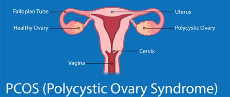 Pcos Cyst Telegraph