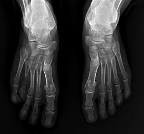 Anteroposterior Radiograph Of Both Feet Of The Patient Demonstrating