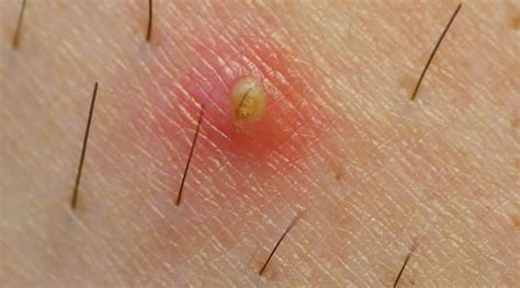 59 Hq Images Ingrown Hair Under Armpit Pictures How To Prevent