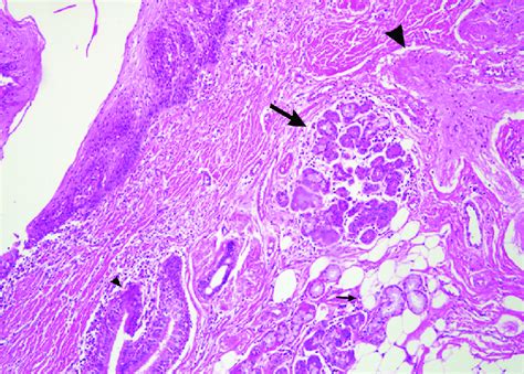 Microscopic Image Of The Mass Shows Sweat Glands Large Arrow Adipose