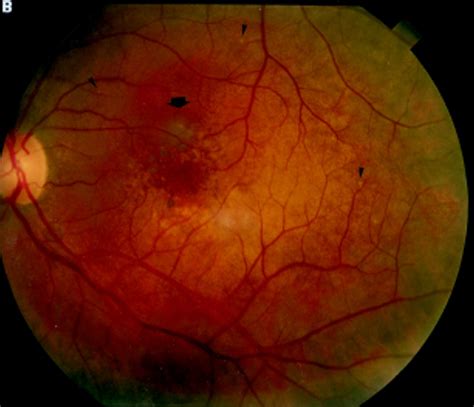 Ocular abnormalities in thin basement membrane disease 