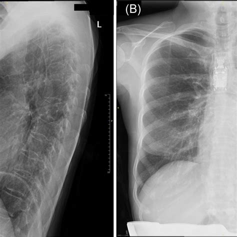 Preoperative Chest X‐ray A Lateral View B Postero‐anterior View