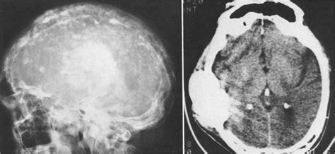 Combined Modality Treatment Of Osteogenic Sarcoma Of The Skull In