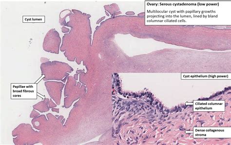 Ovary Serous Cystadenoma Nus Pathweb Nus Pathweb