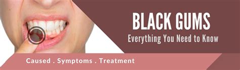 Black Gums Everything You Need To Know