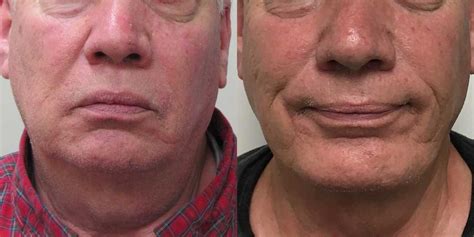 Most women can get back in the water around 3 weeks after surgery. Facial Implants Before and After Photos
