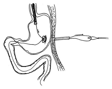 Percutaneous Endoscopic Gastrostomyjejunostomy Pegpej Tube