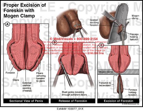 Medivisuals Proper Excision Of Foreskin With Mogen Clamp Medical Illustraion