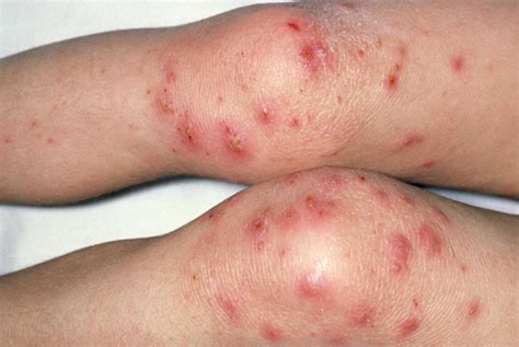 Acute Skin Problems In Children Gponline
