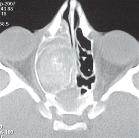 Axial Ct Pns Showing Expansion Of The Right Sinonasal Compartment
