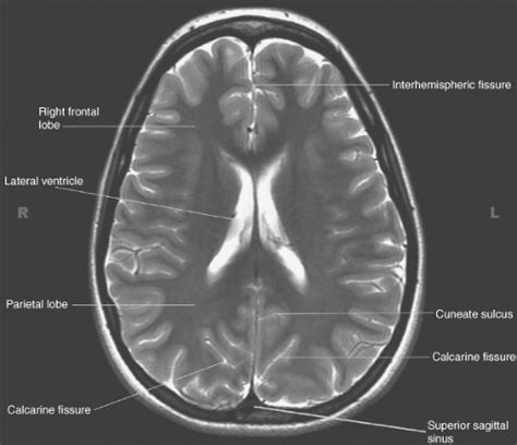 Mri Brain Ventricle Anatomy