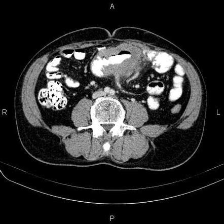 Small Bowel Lymphoma Radiology Case Radiopaedia Org