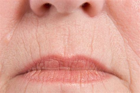 Which Dermal Filler Works Best For Lines Around The Mouth San Diego