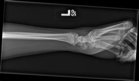 Ortho Dx Wrist Pain Following A Basketball Injury Clinical Advisor