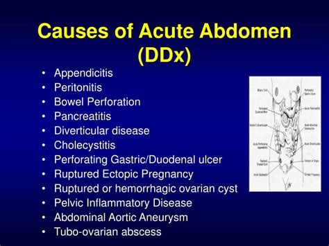 Ppt The Acute Abdomen Powerpoint Presentation Free Download Id173923