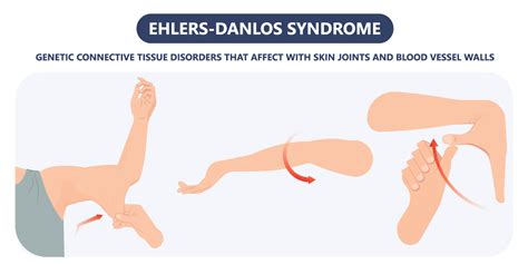Ehlers Danlos Syndromes Eds Elevate Physical Therapy Chicago
