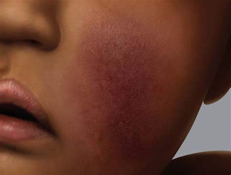 View 35 Eczema On Face Black People