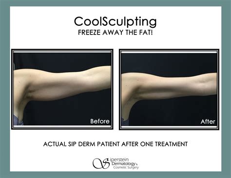 Does Coolsculpting® Really Work Siperstein Dermatology Group