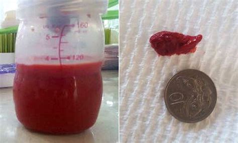 Aussie Mother Shares Confronting Photographs Of Her Red Breast Milk