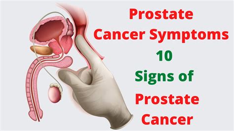 Signs Of Prostate Cancer 10 Signs Of Prostate Cancer Youtube