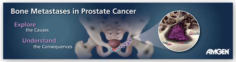 Bone Metastases In Men With Prostate Cancer Ann Marie Wayne