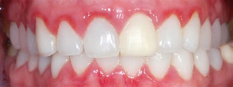 Signs Of Gum Disease How To Recognize Gingivitis