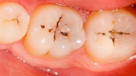 Understanding Dental Caries