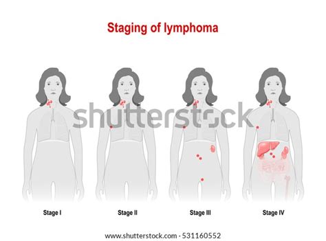 Staging Lymphoma Cancer Lymphatic System Signs Stock Illustration 531160552