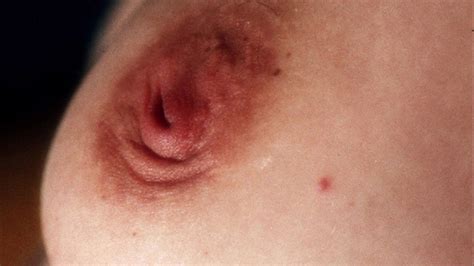 Common But Not Commonly Discussed Inverted Nipples The Plastic