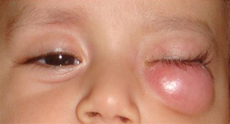 Mri In Retinoblastoma With Orbital Cellulitis Ophthalmology