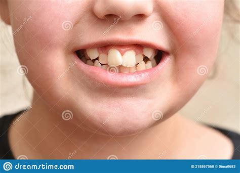 Crooked Teeth In A Child Girl Stock Photo Image Of Dental Smile
