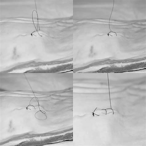 It consists of a simple interrupted stitch placed wide and deep into the wound edge and a second more superficial. Wound Care Review | 2018-01-23 | AHC Media - Continuing ...