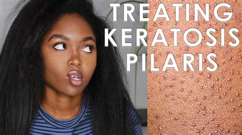 Treating Keratosis Pilaris 3 Easy Steps Youtube