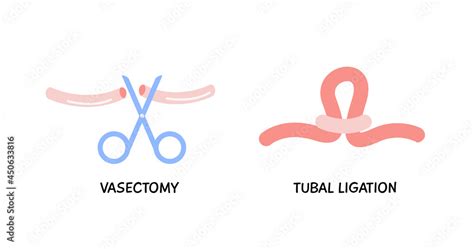 Vasectomy Male Or Female Sterilization Concept Tubal Ligation Colored
