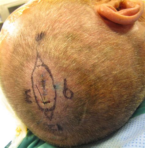 Case Example Sentinel Lymph Node Biopsy Iowa Head And Neck Protocols