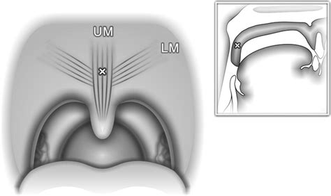 Relocation Pharyngoplasty Operative Techniques In Otolaryngology Head
