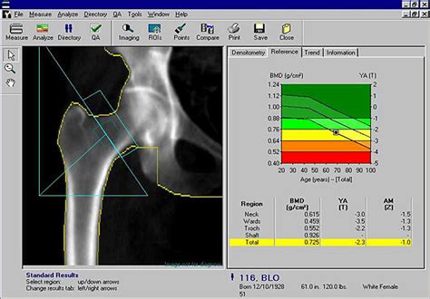 Many different specialists interpret bone density scans, including radiologists, endocrinologists, rheumatologists, gynecologists, and internists. Bone Density Scan. Causes, symptoms, treatment Bone ...