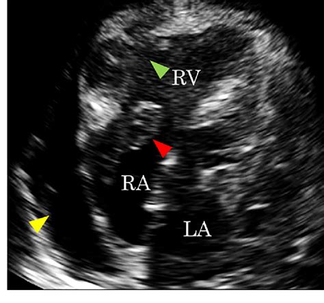 Figure 2 From Primary Cardiac Diffuse Large B Cell Lymphoma Promptly