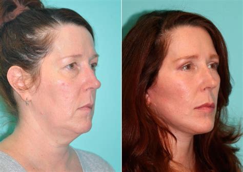 Facelift Neck Lift Photos Chevy Chase Md Patient 14855