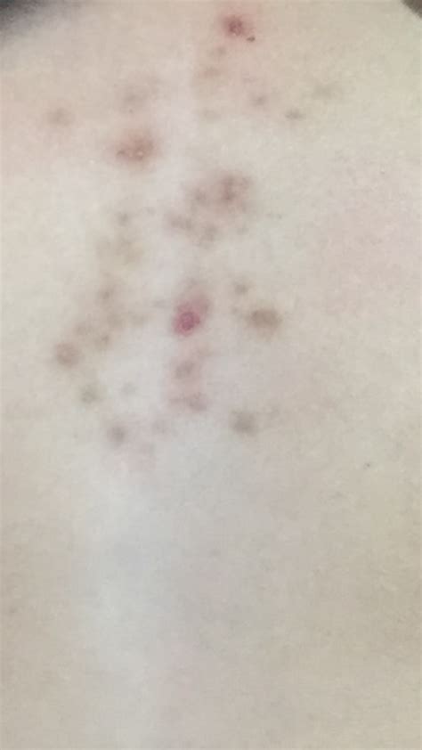 Skin Concerns How To Remove These Brown Spots From My Chest After