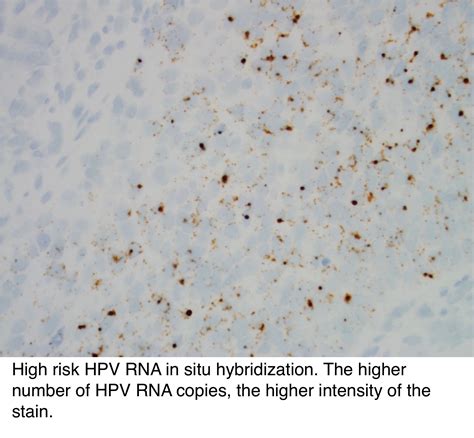 Pathology Outlines Hpv Related Oropharyngeal Squamous Cell Carcinoma