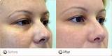 Prp Eye Treatment Pictures
