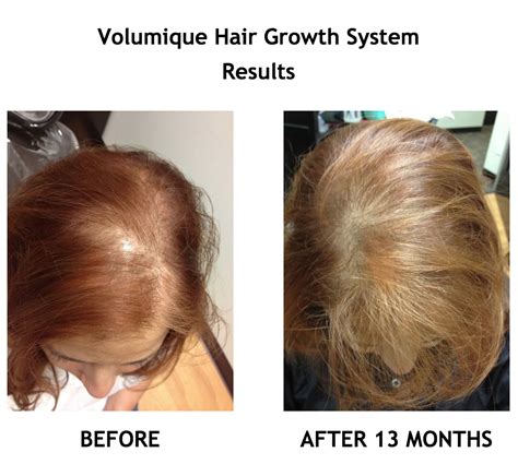 Volumique Solutions Step 3 Restore Scalp And Follicle Treatment Hair