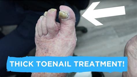 How To Treat A Thick Toenail And Our Holiday Vlog Youtube