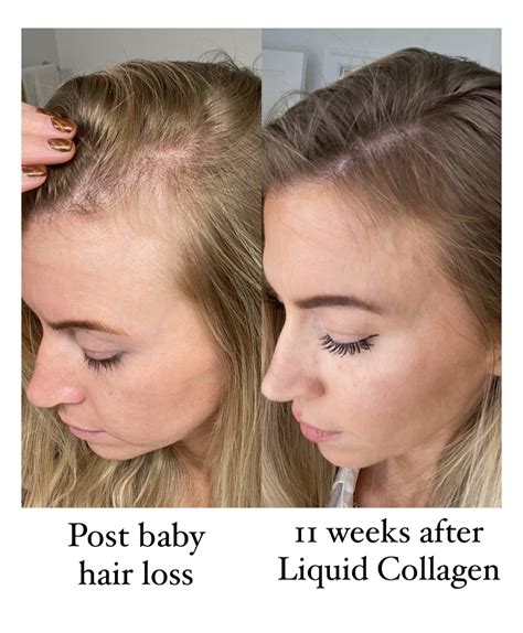 Top 48 Image Collagen Before And After Hair Vn
