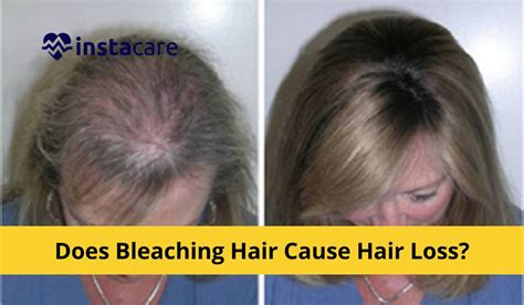 The Hair Loss Risks Of Bleaching Your Hair What You Need To Know