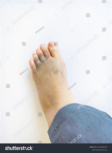 Left Foot Bruise Contusion Swollen Cause Stock Photo Shutterstock