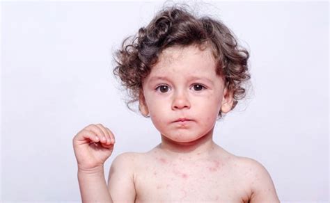 Allergies To Sweat In Children Symptoms And Treatment You Are Mom